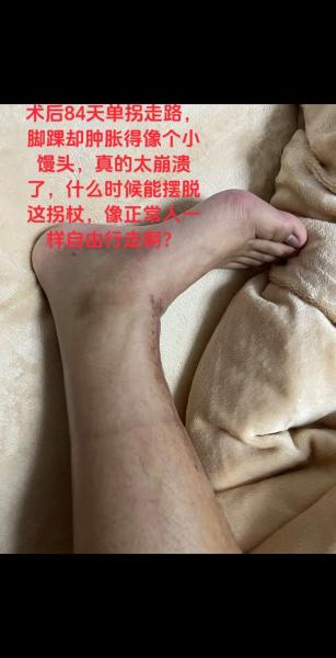 慎入，利兹球员施塔赫展示自己严重肿胀的脚踝，以回击质疑者